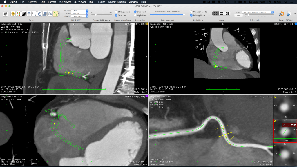 osirix md curvedmpr